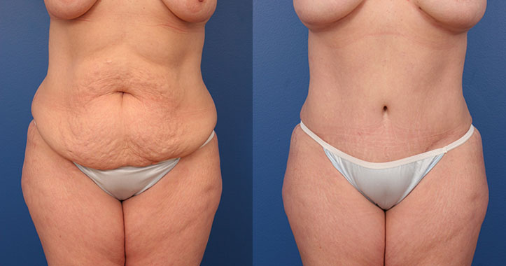 Abdominoplasty and Liposuction to Bilateral Flanks Case #37493 - The  Plastic Surgery Group, flanks