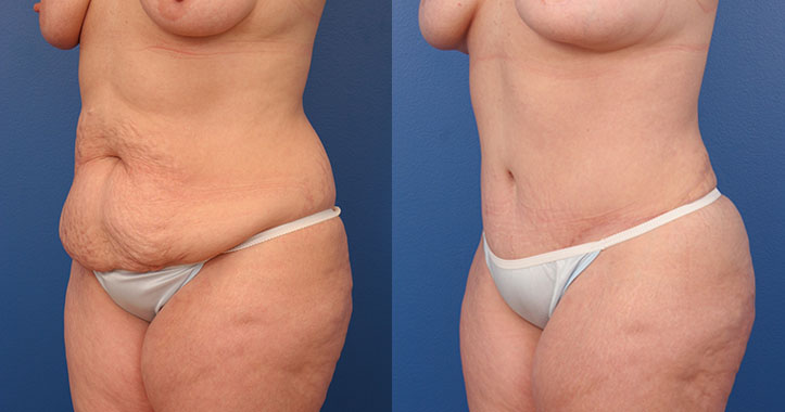 Abdominoplasty and Liposuction to Bilateral Flanks Case #37493 - The  Plastic Surgery Group
